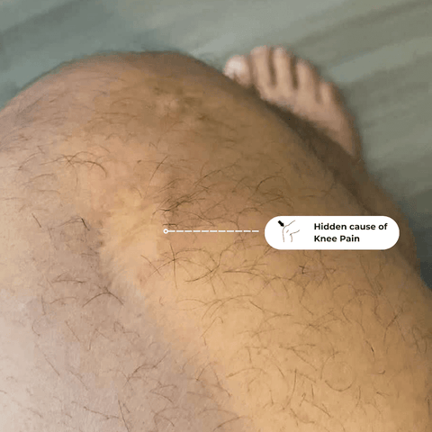 Scars and Knee Pain