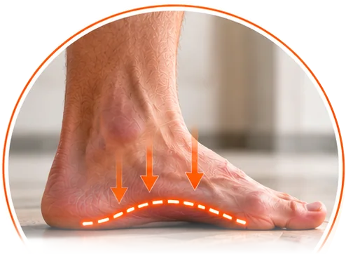 Close-up of a flat foot, with arrows showing the arch pressed down to the floor