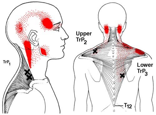 This might be the cause of your stiff neck