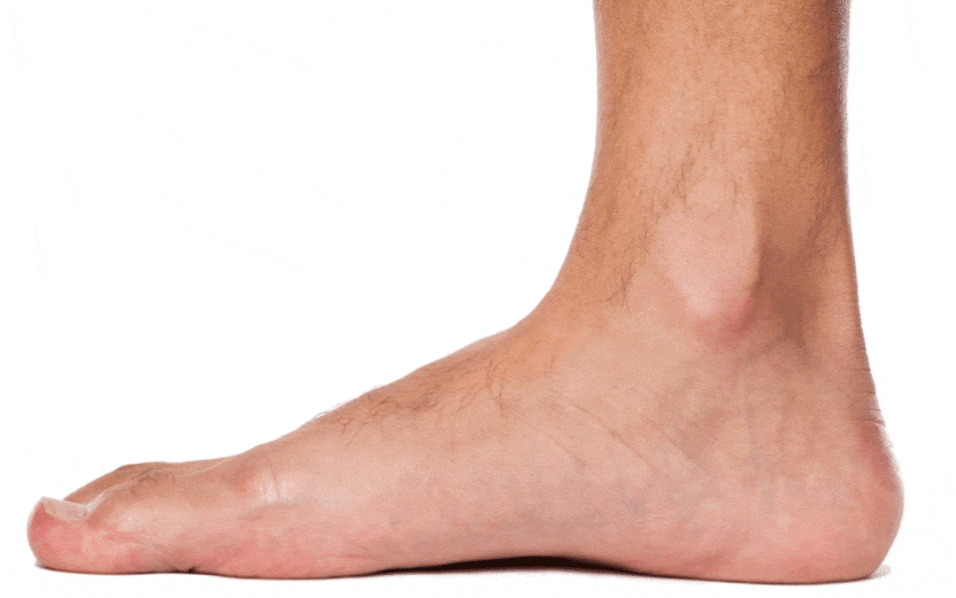 Flat Feet- What the Story?