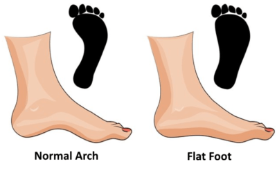 3 TIPS to Correct Flat Feet