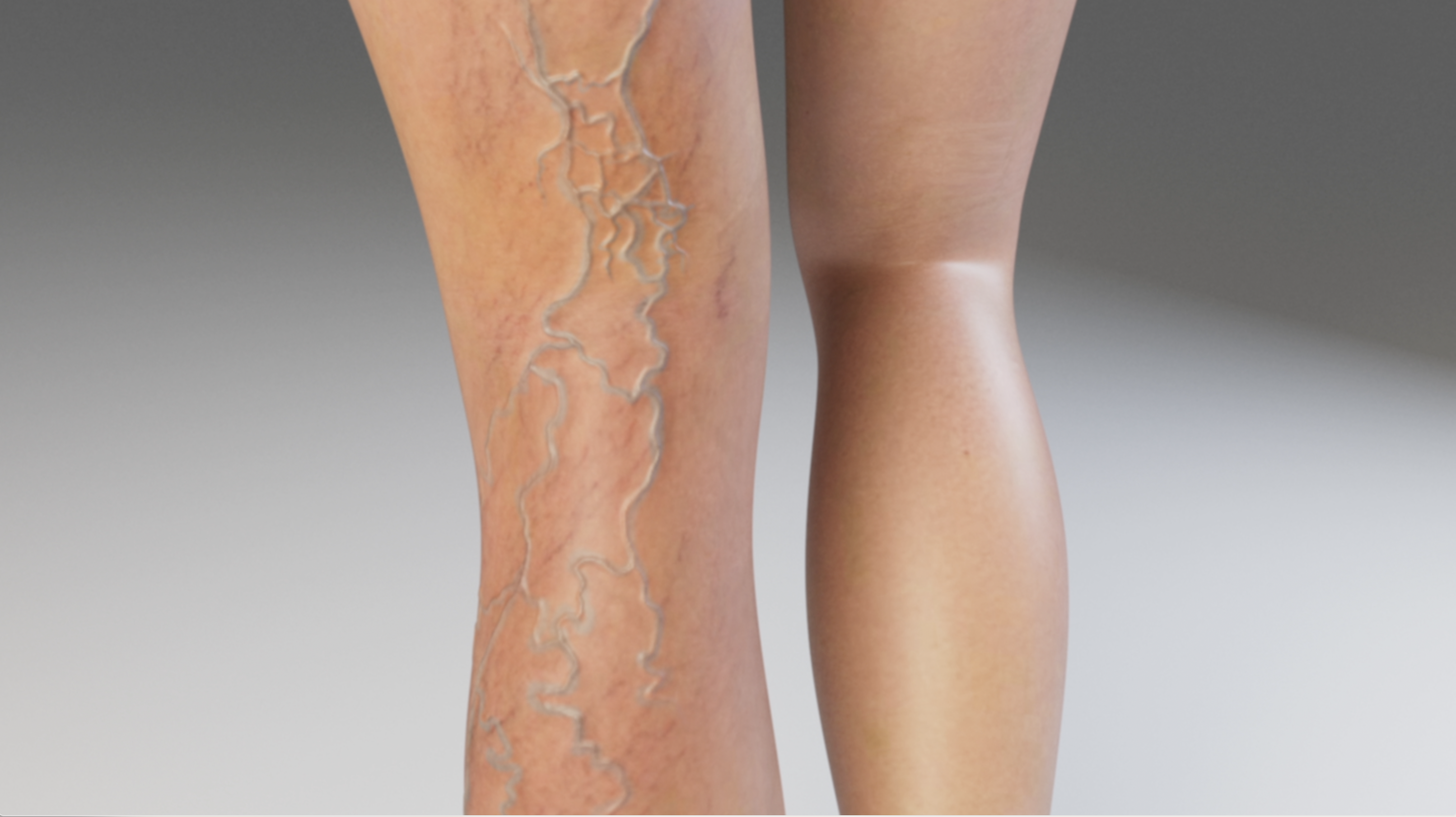 formation-of-varicose-veins