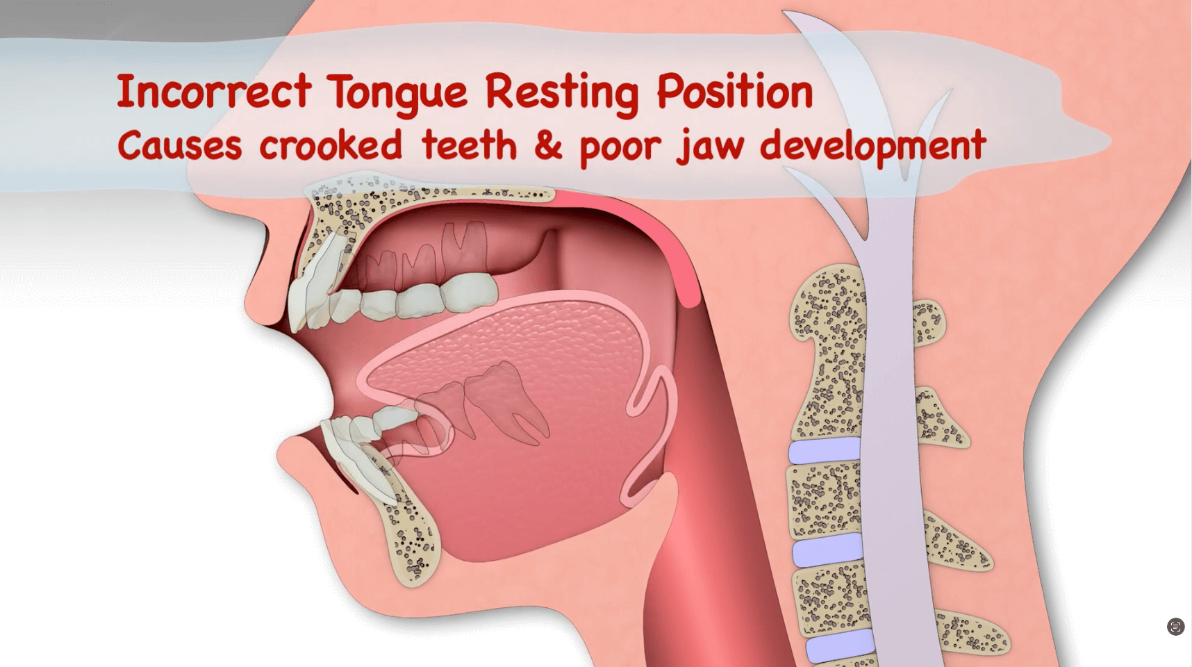 Incorrect Tongue Position